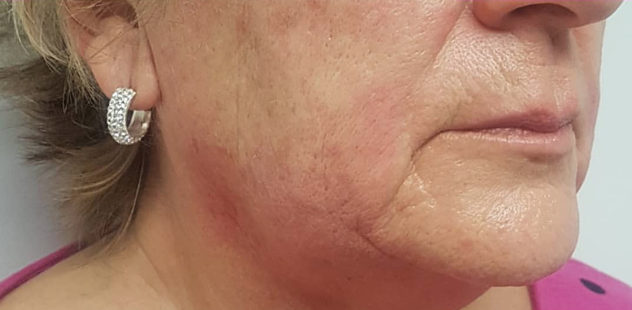 CACI Non-Surgical Face Lift Before & After - Winslow Skincare