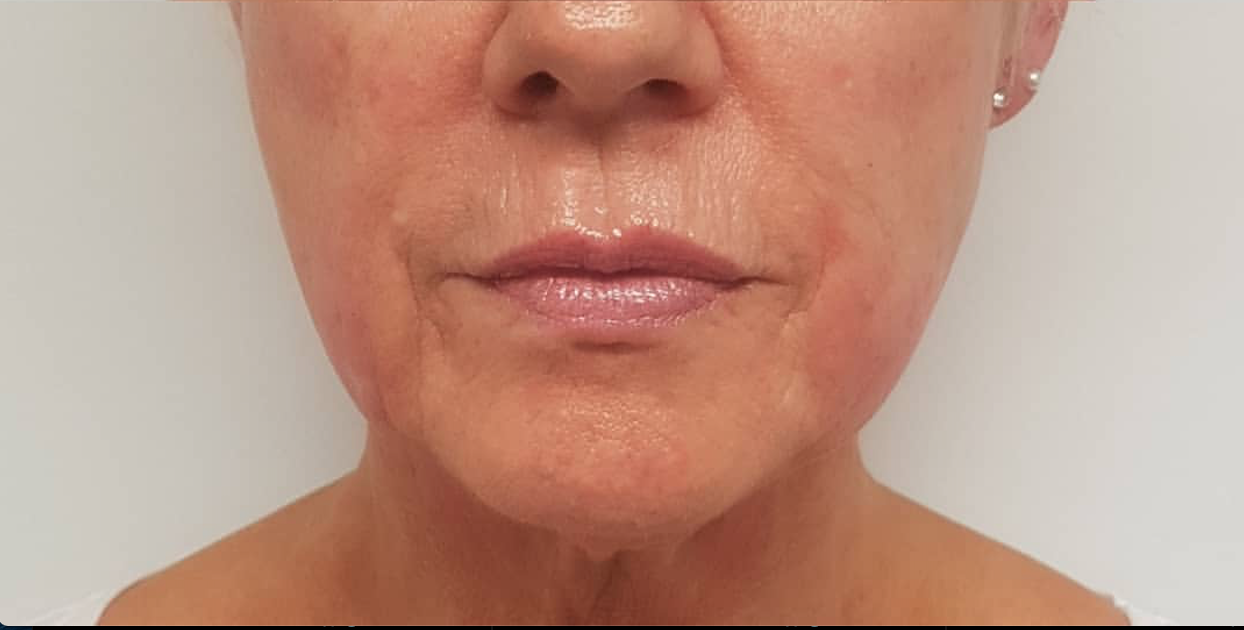 CACI Non-Surgical Face Lift Before & After - Winslow Skincare