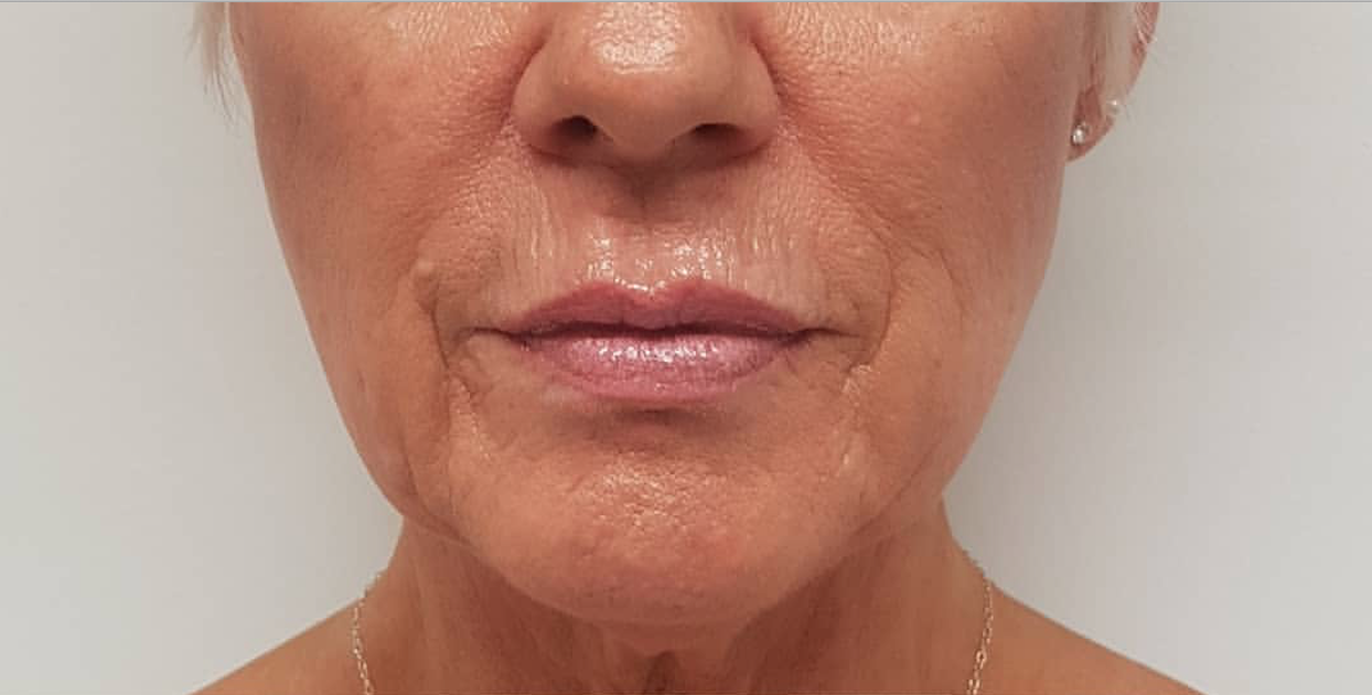 CACI Non-Surgical Face Lift Before & After - Winslow Skincare
