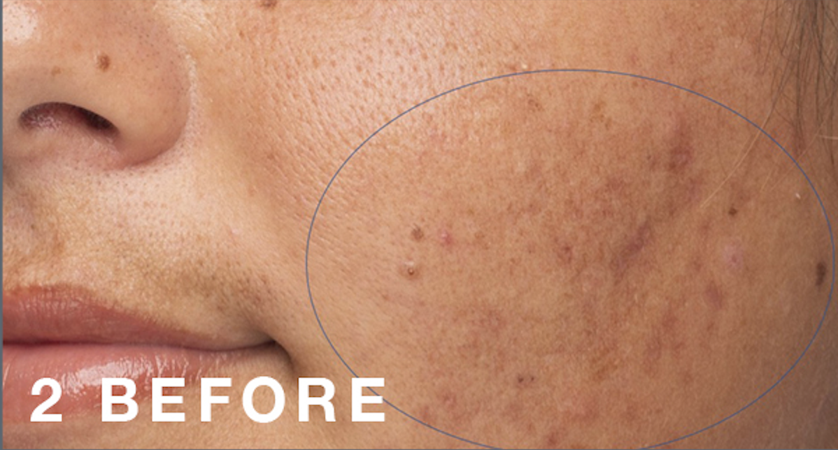 ProPower Peel