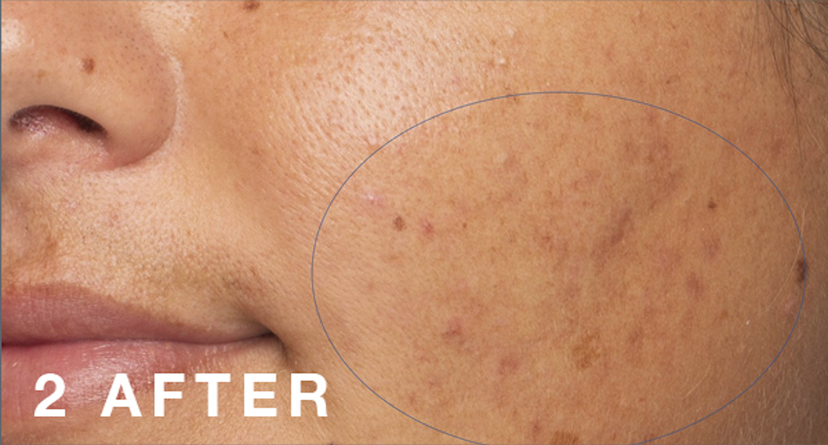 ProPower Peel