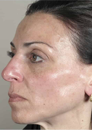 CACI Microdermabrasion Before & After - Winslow Skincare