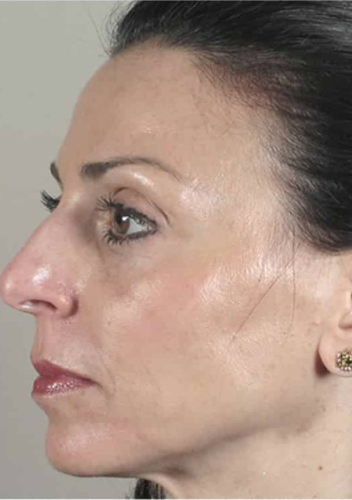 CACI Microdermabrasion Before & After - Winslow Skincare