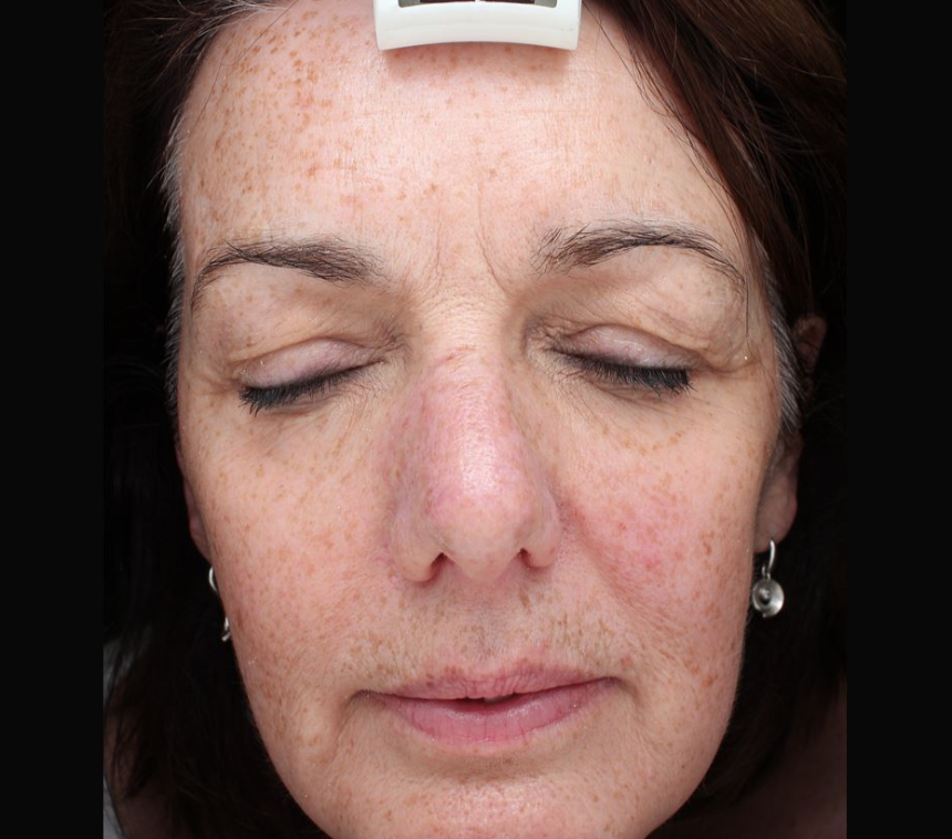 Light Fusion Before & After - Winslow Skincare