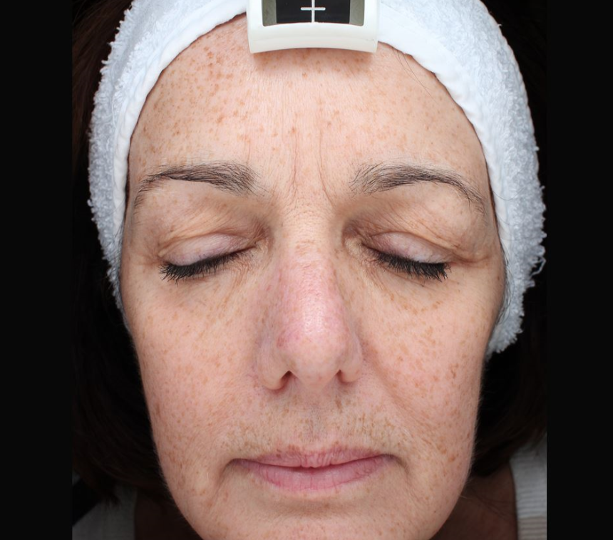 Light Fusion Before & After - Winslow Skincare