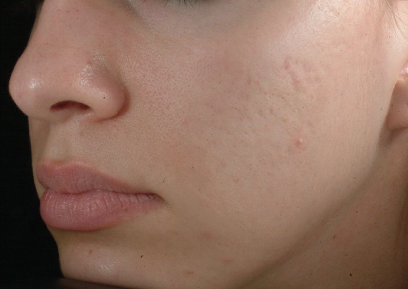Microdermabrasion Before & After - Winslow Skincare