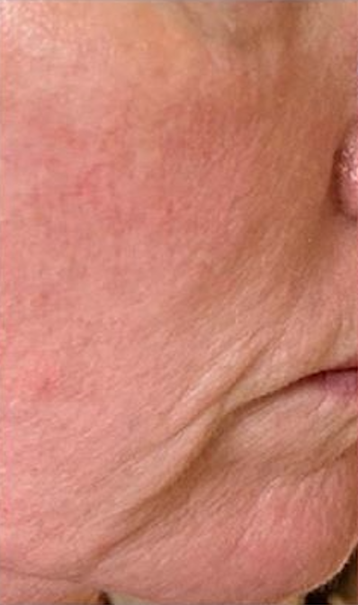 Radio Frequency Before & After - Winslow Skincare