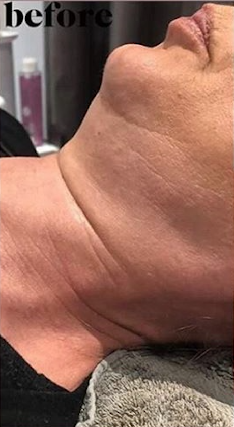 Radio Frequency Before & After - Winslow Skincare
