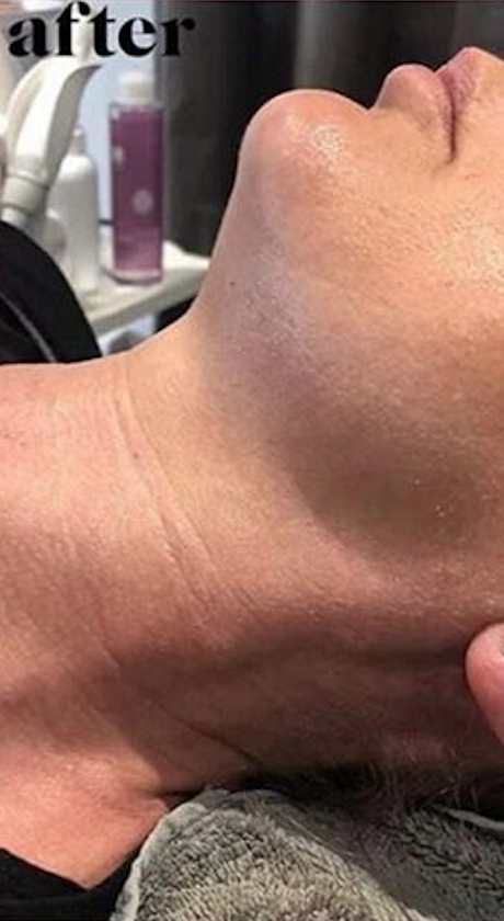 Radio Frequency Before & After - Winslow Skincare