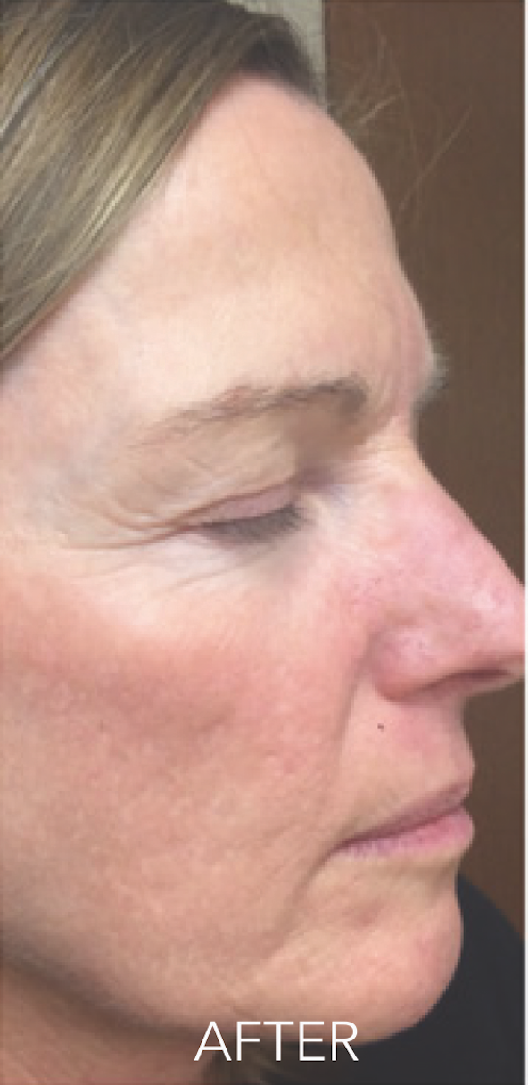 Micro-Needling Haywards Heath