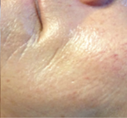 Micro-Needling After