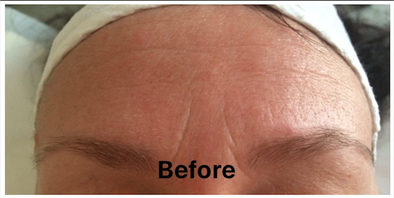Frown Treatment