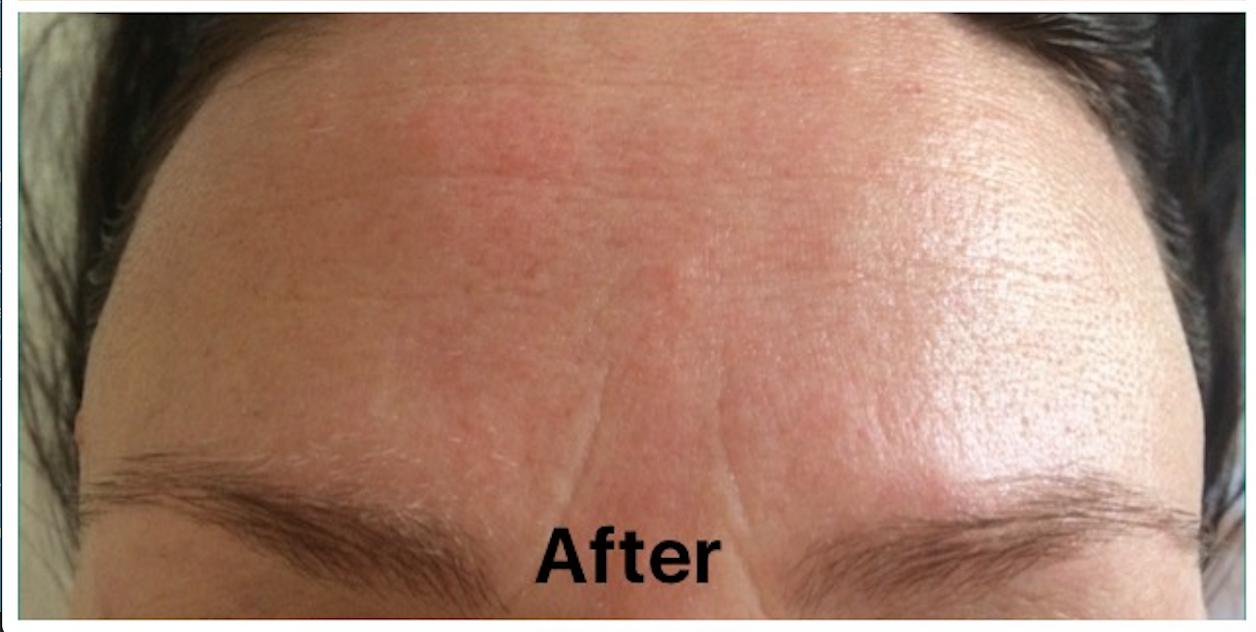 Frown Treatment After