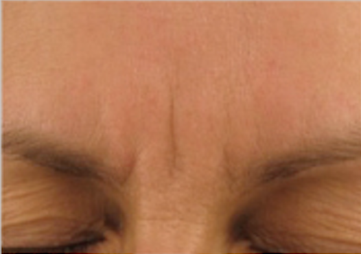 Frown Serum Treatment Environ - Winslow Skincare